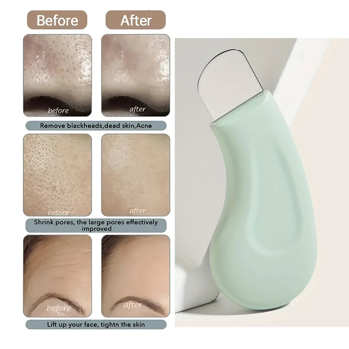 Outil Anti-Points Noirs & Pores | Nettoyant Visage Professionnel | Peau Nette & Purifié